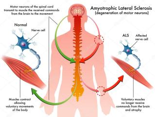 depositphotos_59206423-stock-illustration-als-amyotrophic-lateral-sclerosis